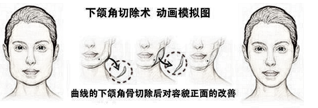 上海整形医生建议我做下颌角手术，有必要吗？