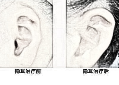 朔州丽都整形医院隐耳矫正果怎么样 价格是多少