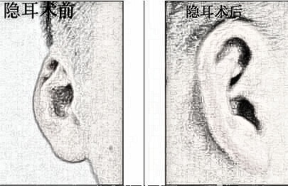 朔州丽都整形医院隐耳矫正果怎么样 价格是多少