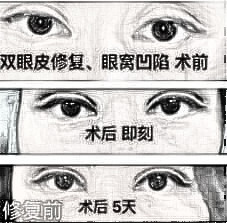 双眼皮失败介绍大全：深度解析失败原因