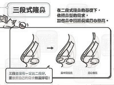 如果做三段式假体隆鼻，那要垫耳软骨吗？