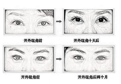 开眼角如何避免疤痕？