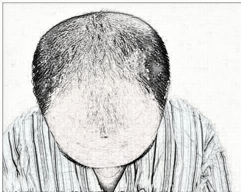 秃顶植发需要多少钱？头顶大面积种植介绍分享！