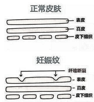 做激光妊娠纹修复需要多少钱