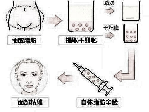 自体脂肪填充脸颊会不会出现凹凸不平的现象