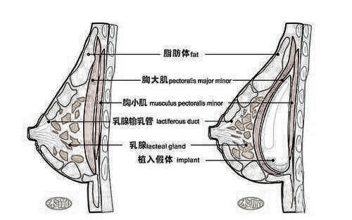 做曼托圆盘假体隆胸需要注意哪些?