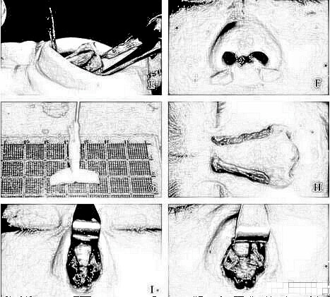 亚洲肋骨软骨鼻整形术是怎样的？