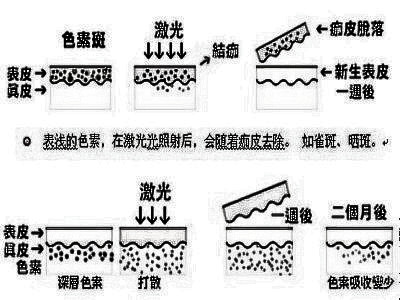 激光祛斑后反黑正常吗