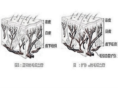 怎样祛除红血丝保养肌肤呢