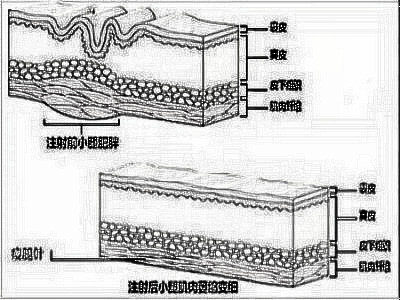 注射瘦腿和抽脂瘦腿哪个更好