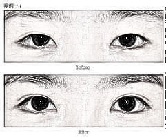 山东中医药大学整形医院双眼皮手术价格是多少