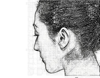 北京凯润婷整形医院副耳切除术的优势 有哪些禁忌
