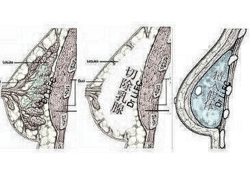 三明第二醫院整形科乳房再造的優勢有副作用嗎