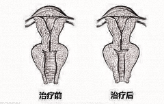 紧缩术 准妈妈不再害怕顺产