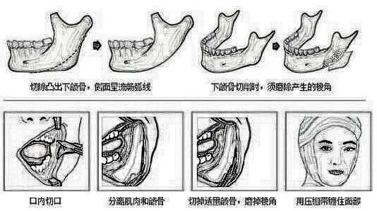 磨骨瘦脸需要多少钱 手术没问题吗