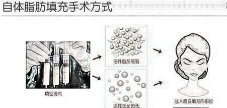 乌鲁木齐梁青松自体脂肪丰苹果肌好吗