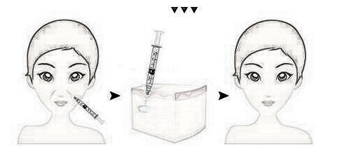 上海维纳斯注射祛法令纹多少钱