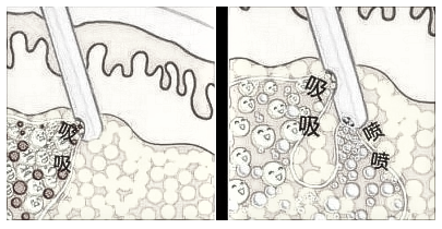 水动力和360吸脂的区别？