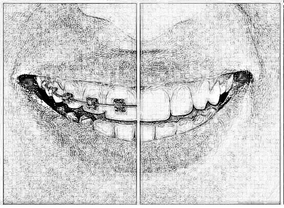 嘉兴禾美成年人地包天矫正方法 地包天矫正价格