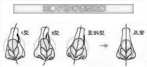 南京维多利亚整形：鼻歪矫正有什么副作用？术前术后图分享