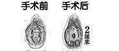 东莞现代妇科医院妇科整形膜修复价格 多久恢复