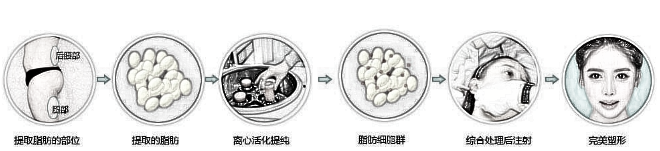 脸部脂肪填充多久恢复自然