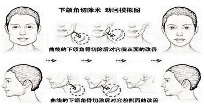 北京中月宏下颌角整形方法
