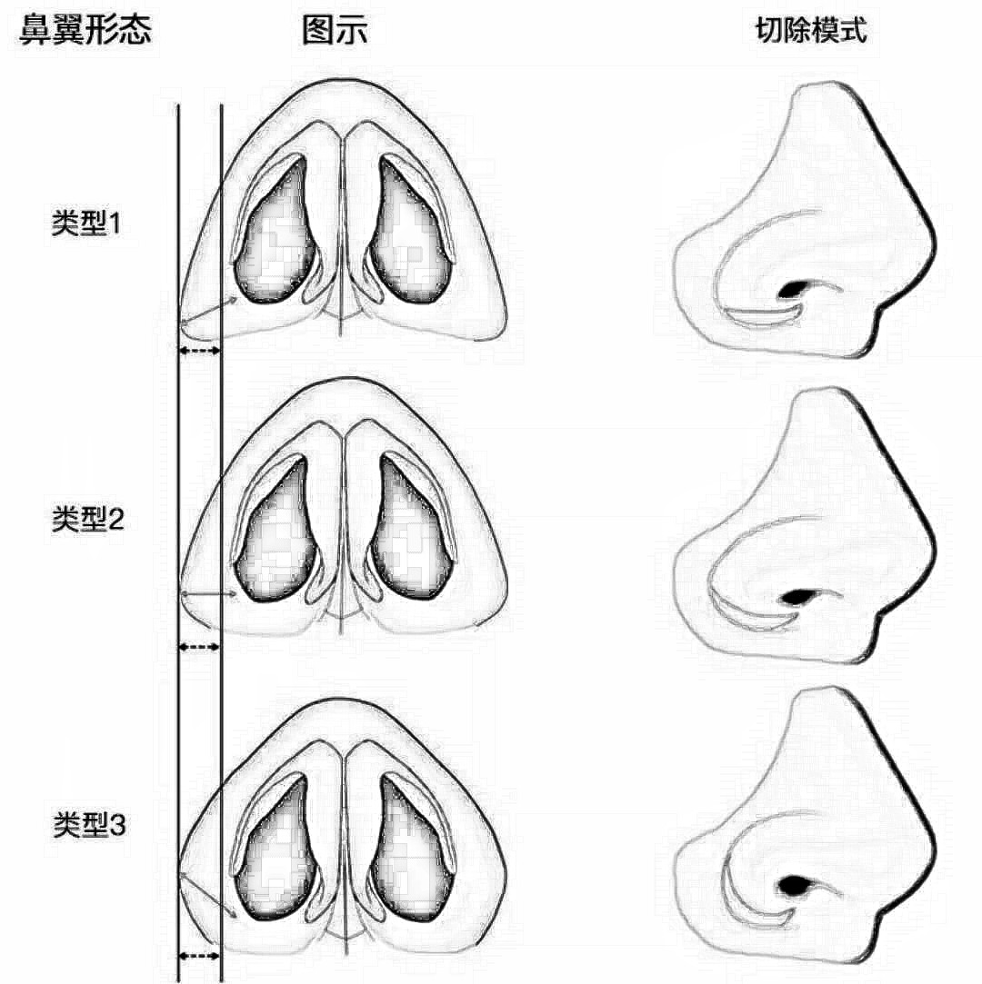 鼻子肥大怎么变小？