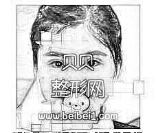 北京苏亚医院分享注射瘦脸注射介绍 脸型好看了附加照片