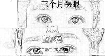 潍坊医学院整形外科医院牟少春医生做的双眼皮+开眼角 来看看吧