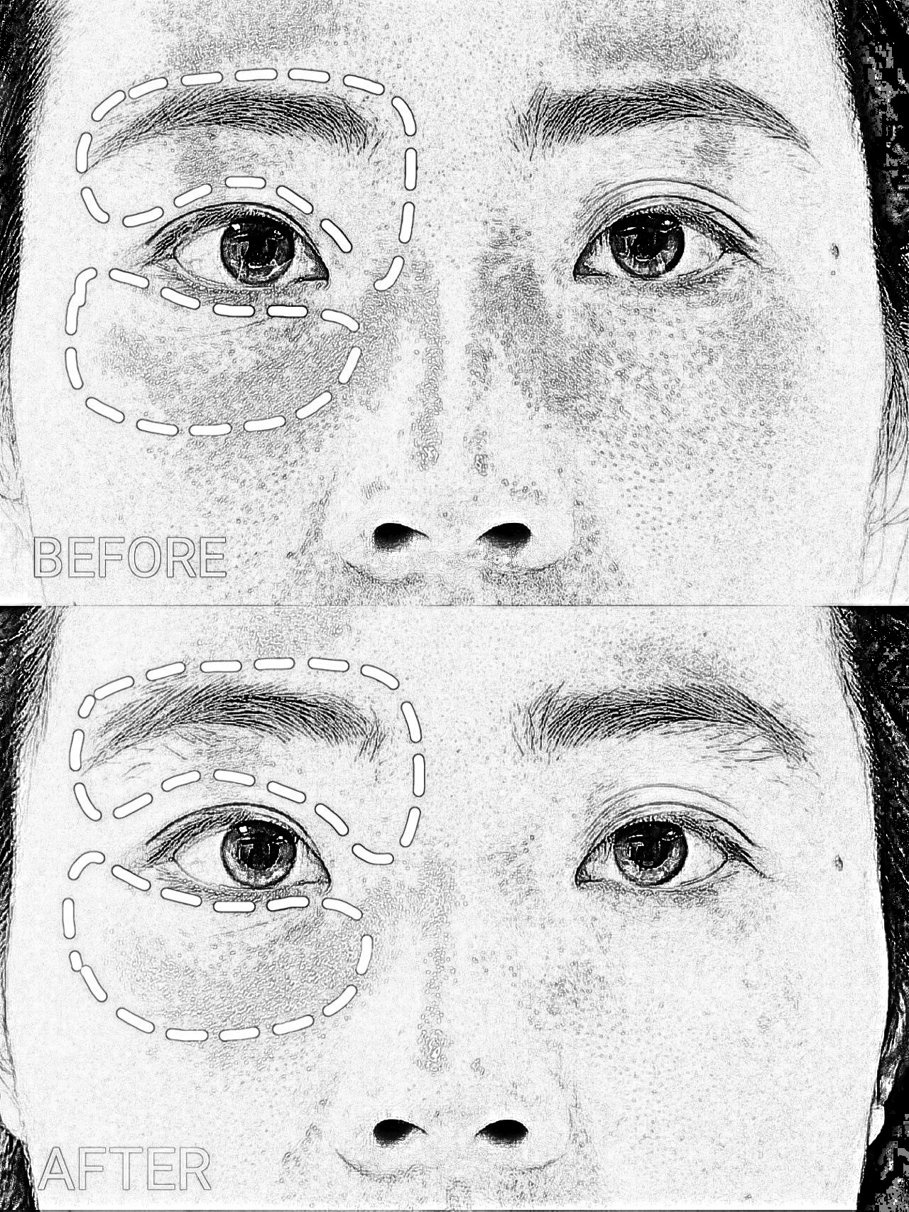 深圳黄金媚眼双眼皮的第30天，这次黄金媚眼的体验主要项目就是做的眼部黄金微针