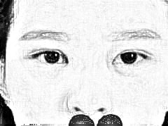 河北省中医整形刘博医生双眼皮修复介绍 这次的修复还是十分的成功的，手术之后我也一直都有使用防止留疤的用于眼部的膏药