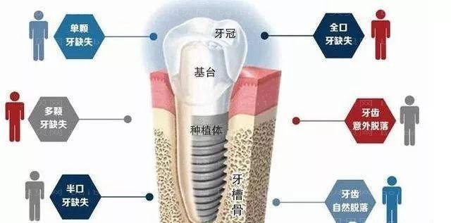 西安第四军医大学种植牙价格