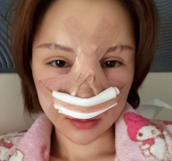 上海华美医疗美容医院李庭勋隆鼻介绍