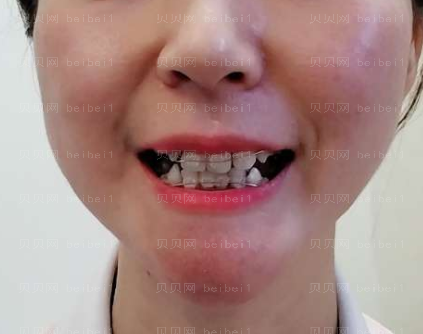 上海华美医疗美容医院黄嵩—牙齿矫正介绍