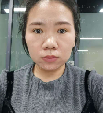 济南艺星医疗美容医院刘近兰热提拉介绍片较新分享_人眼由此可见苹果肌上移了，脸也变小了