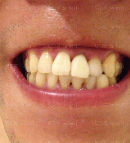 深圳阳光整形美容医院安浩军牙齿种植介绍片较新分享——目前为止牙齿没有出现过任何问题，一切都挺好的