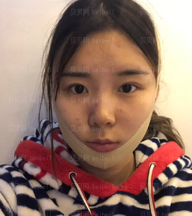 深圳臻瑞芝美医疗美容门诊部高焱下颌角磨骨介绍片较新分享——伤口已经基本上恢复了，虽然在嘴巴里面我自己看不到，但是还是可以感觉得到的