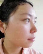 深圳臻瑞芝美医疗美容门诊部李远宏激光祛斑介绍片较新分享——我的皮肤现在已经恢复的越来越好了呢，而且之前的肤色不均、毛孔粗大等情况也都改