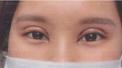 深圳臻瑞芝美医疗美容门诊部慕昕双眼皮介绍片较新分享——恢复到现在，眼睛看起来真的是越来越好看了