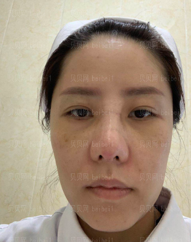 深圳臻瑞芝美医疗美容门诊部慕昕肋软骨隆鼻介绍片较新分享——鼻子已经恢复的比较自然了，感觉越来越好看了呢