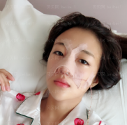 广州韩妃医学美容医院 于洪瑞医生 鼻部修复案例分享