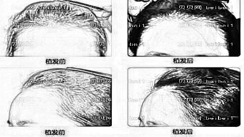 重庆新生植发怎么样？哪个医生技术好