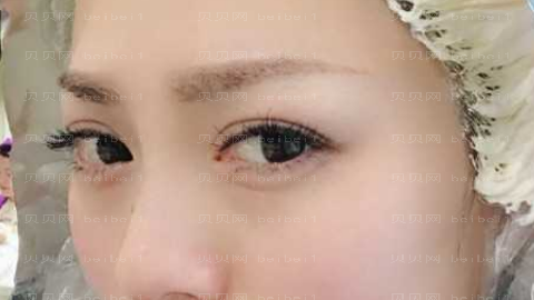 成都美极开眼角怎么样?成都美极整形开眼角介绍,值得期待!