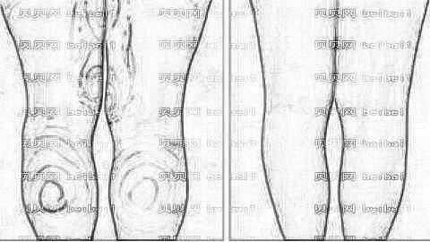 陈仕文做全身吸脂技术靠谱吗？脂肪医生陈仕文吸脂介绍