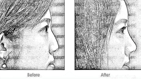 南京亚韩隆鼻大概多少钱？南京亚韩整形+医生介绍曝光！