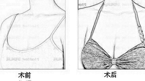 成都十大隆胸医生介绍|谢凯英、郭晓进、李烈等知名专家来袭