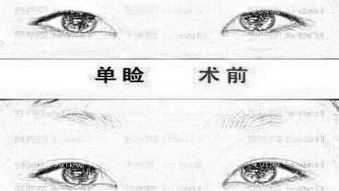 李海霞医生双眼皮技术好不好？附医生简介+李海霞双眼皮介绍展示