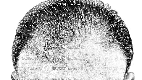 西安交大二附院植发果怎么样?,植发手术介绍及公布整形价位表