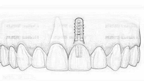 徐州二院种植牙怎么样?种植牙手术介绍及整形